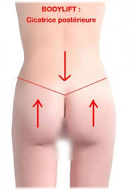 Cicatrizes da abdominoplastia 360° graus