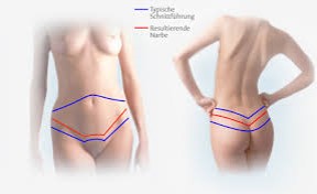 Umbigo na abdominoplastia 360°