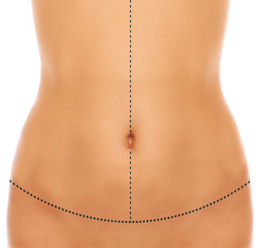 Cicatriz na abdominoplastia em âncora