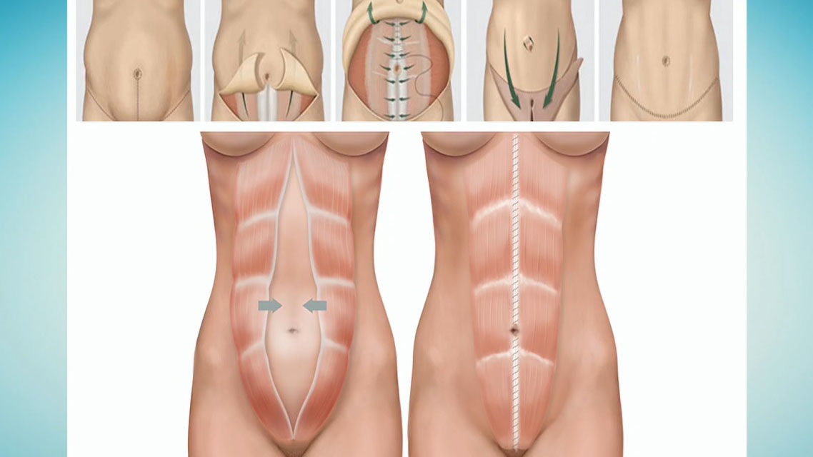 Cicatriz e diástase na abdominoplastia