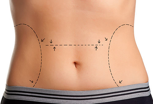 Região onde é realizada a abdominoplastia