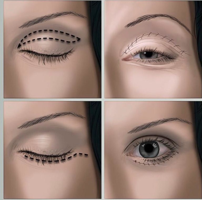Cicatrizes na blefaroplastia