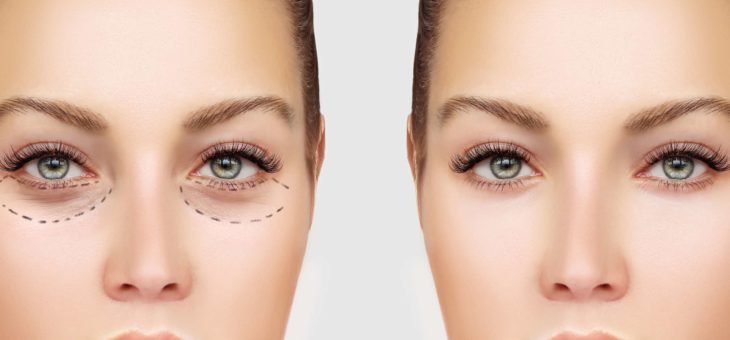 Evolução pós-operatória da blefaroplastia