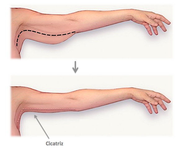 Procedimento braquioplastia
