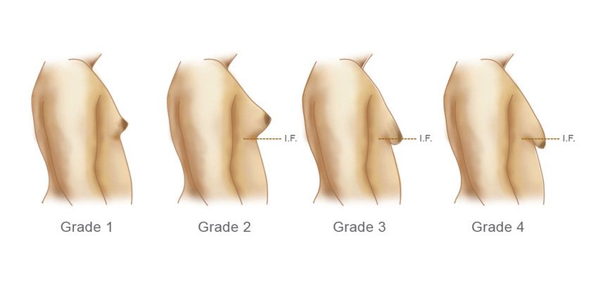 Técnicas de tratamento da ginecomastia
