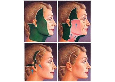 Lifting de face — cicatrizes