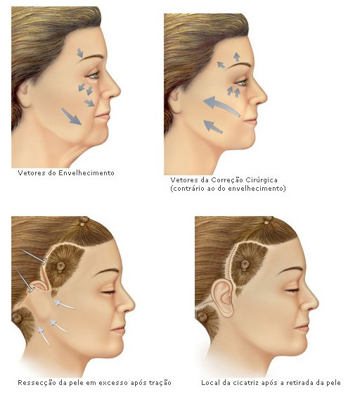 Lifting de face — local das cicatrizes