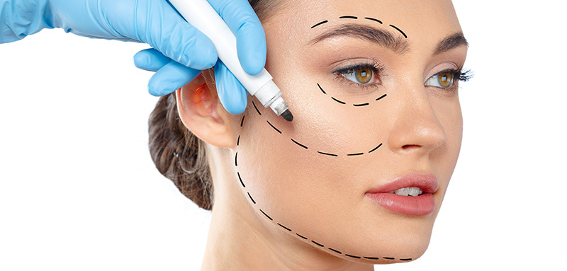 Lifting de face — ritidoplastia
