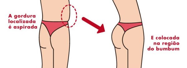 Lipoaspiração e lipoescultura