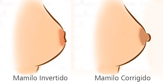 Correção de mamilo invertido