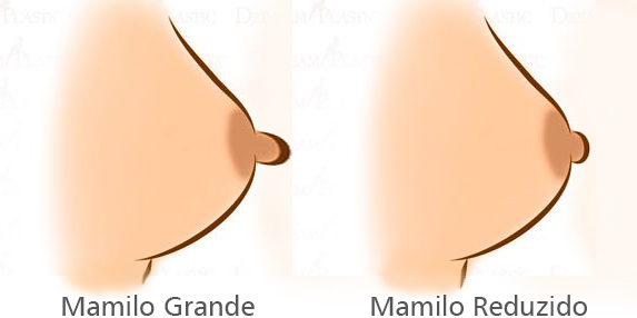 Mamilos reduzidos após mamiloplastia