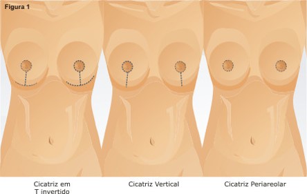 Cicatriz em mastopexia