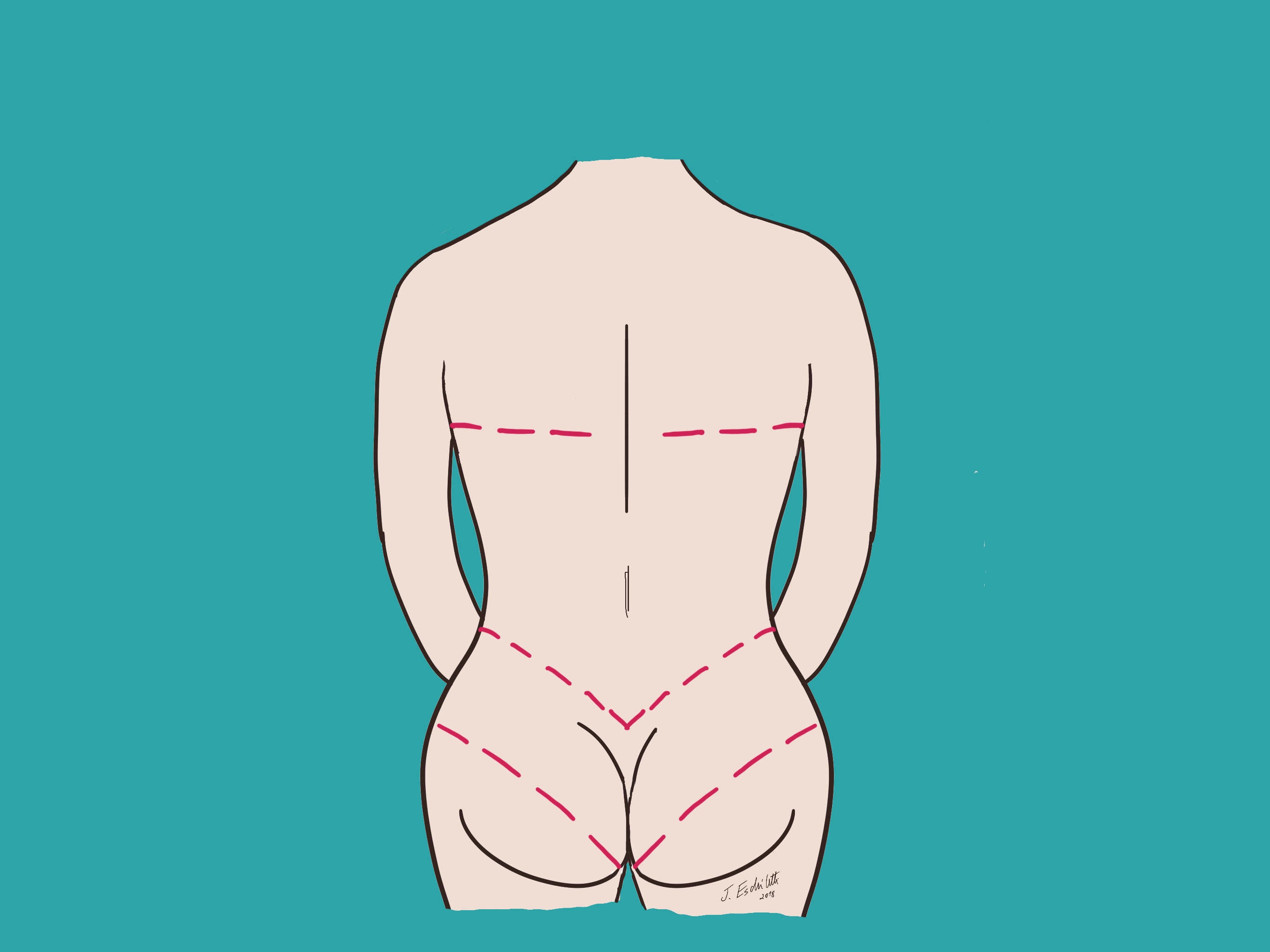 Procedimento toracoplastia